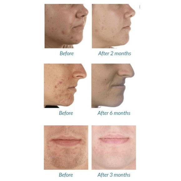 Silk'n Blue Acne Light Therapy Solutions for Clear Skin NEW - Picture 3 of 4